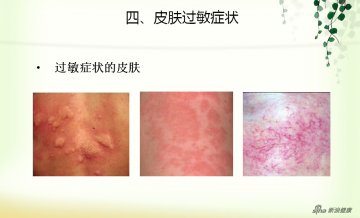 皮肤过敏