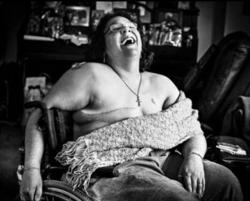 高清：解禁！国外乳房切除手术后照片