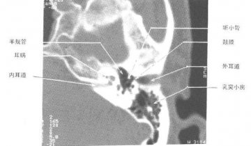 正常耳部CT（2）