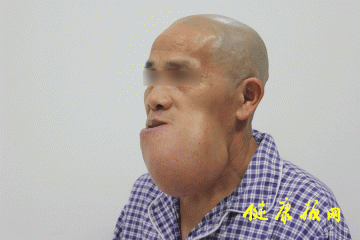 临床快递：湘雅专家为下颌长瘤男子“换脸”
