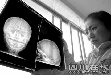 11岁女孩颅内藏5厘米钢针11年