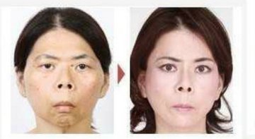 日本整形医院惊悚整容对比照大曝光