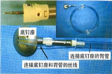 武警总医院成功实施国内首例经口腔置入钉砧头的OrVil式腹腔镜下胃转流手术