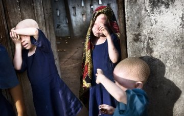 摄影师实拍非洲白化病患者