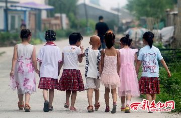 吉林六岁女孩不长头发 父母急盼重生秀发良方