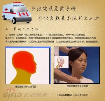 指压止血方法：颈总动脉压迫法