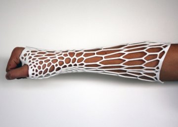 全新3D“Cortex”让病人告别石膏的脏、臭年代