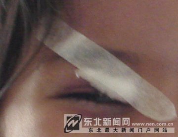 3厘米长铅笔屑藏在5岁女孩眼里一年多
