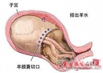 医学图解：剖腹产手术全过程