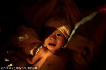5个月男婴得怪病肚如气球