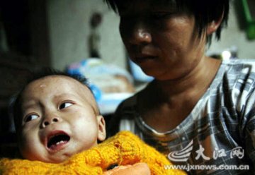 11个月女婴不长身高长皱纹