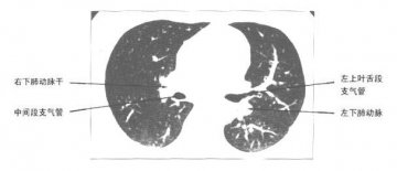 正常胸部肺窗CT（4）