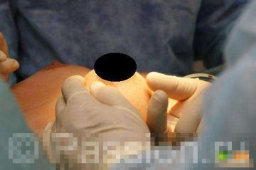 实拍国外隆胸手术全程