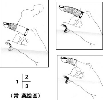 钢戒卡手指细线解难题