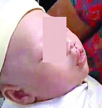 孕妇产检正常生下婴儿却唇腭裂 家人诉医院索赔