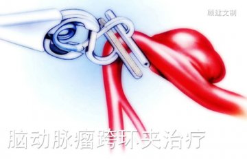 神奇的跨血管动脉瘤夹