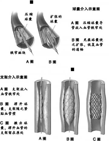 穿行在心脏险区——听老吕讲述介入的故事
