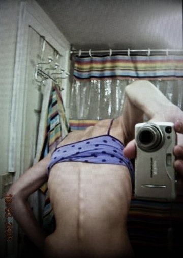 实拍厌食症患者的身体