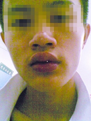 男子感冒输液后变成“香肠嘴”