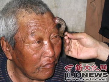 76岁老汉长“犄角”能拽又能转图
