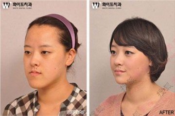 31个惊人韩国整容案例