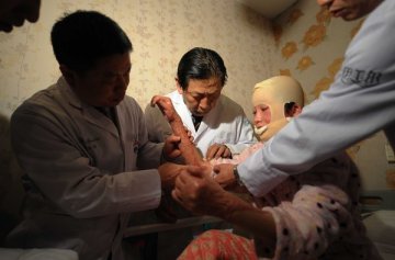 安徽被毁容少女周岩抵京治疗