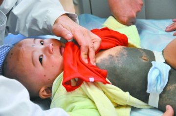 男婴近半皮肤覆盖黑色兽皮痣 最厚部位达8毫米