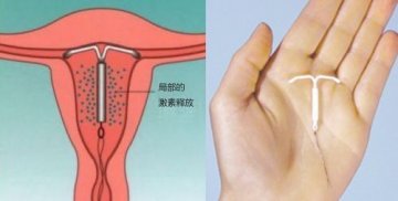 女性上避孕环全过程