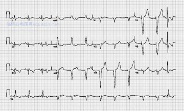 心室起搏Ventricular pacemaker
