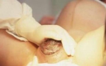 实拍孕妇顺产惊心全过程