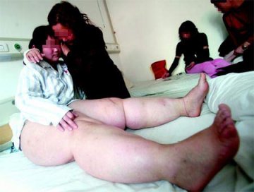 19岁少女腿围90厘米 比常人腰粗