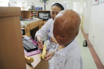 奥特曼男孩王小鹏在北京住院后的日子