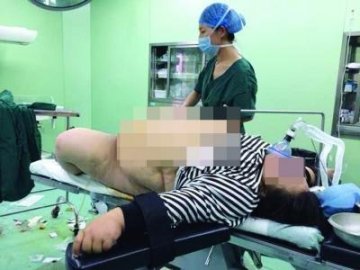 350斤孕妇产二胎 5名医生忙4小时取出孩子