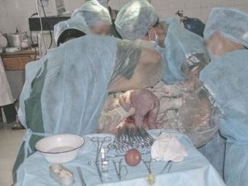 人体探秘：实拍剖腹产震撼生产过程