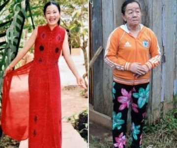 越南一女子过敏后患怪病短时间内衰老50岁