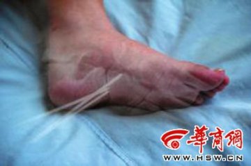 患者右脚骨裂左脚被手术 周至县联合医院院长称系误会