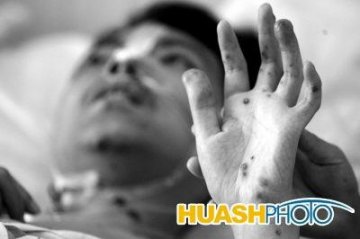 男全身布满100多血管瘤全球仅5例