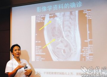 武汉一孕妇宫颈内怀胎7月生下女婴创造奇迹