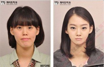31个惊人韩国整容案例