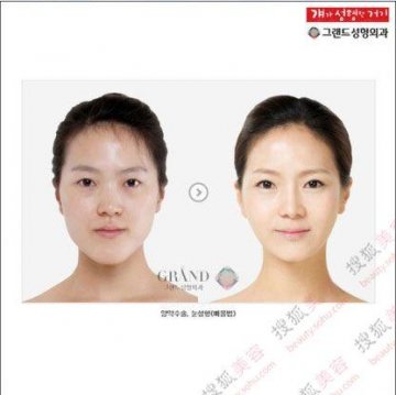 31个惊人韩国整容案例