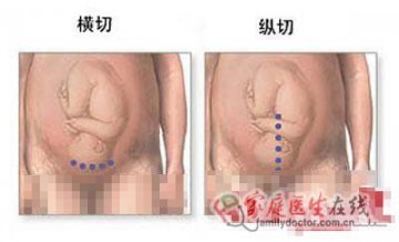 医学图解：剖腹产手术全过程