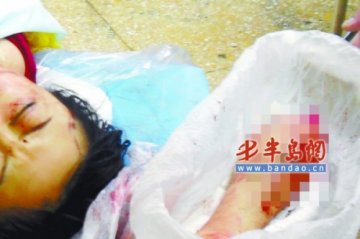 女子遭男友残虐受重伤 右臂被用水果刀自肘部分离