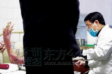 男子为救工友跳入火海全身烧伤面积超90%