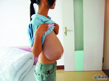 16岁少女患“巨乳症” 双乳16斤到肚脐位置