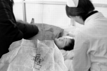 两岁宝宝好奇吞10枚汽排钉 深嵌食道四小时取出