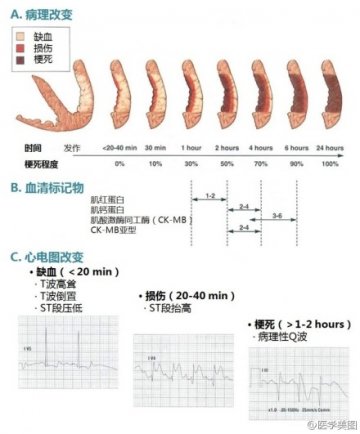 信息图：心肌梗死各阶段的表现