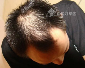 为什么男人容易谢顶？