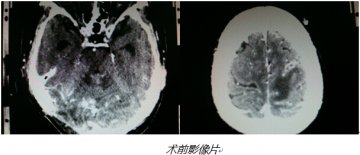 拿什么来拯救脑转脑移瘤患者？