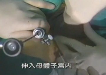 实拍少女人流全过程