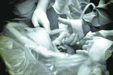 美国新生女婴母亲子宫中紧紧抓住医生手指